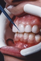 Facetas dentárias, clareamento dentário, estética dentária - Dentista Boqueirão, Santos/SP