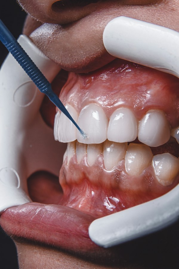Scaling & Polishing
