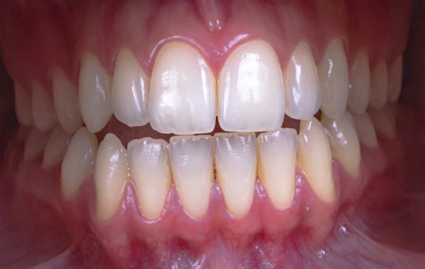 Close-up of patient teeth and gums periodontal treatment