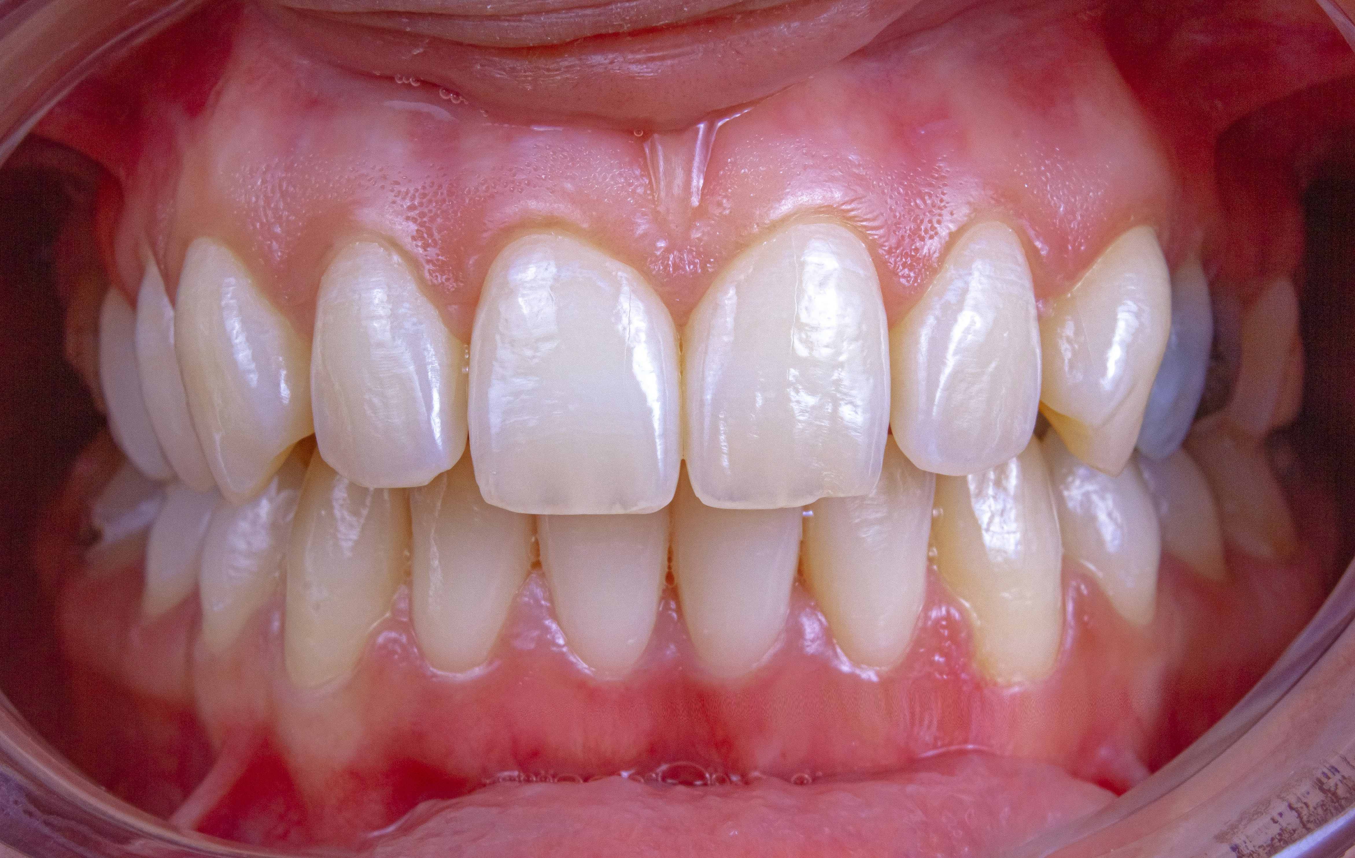 Demystifying Tooth Chart and Numbering Systems: A Comprehensive Guide 