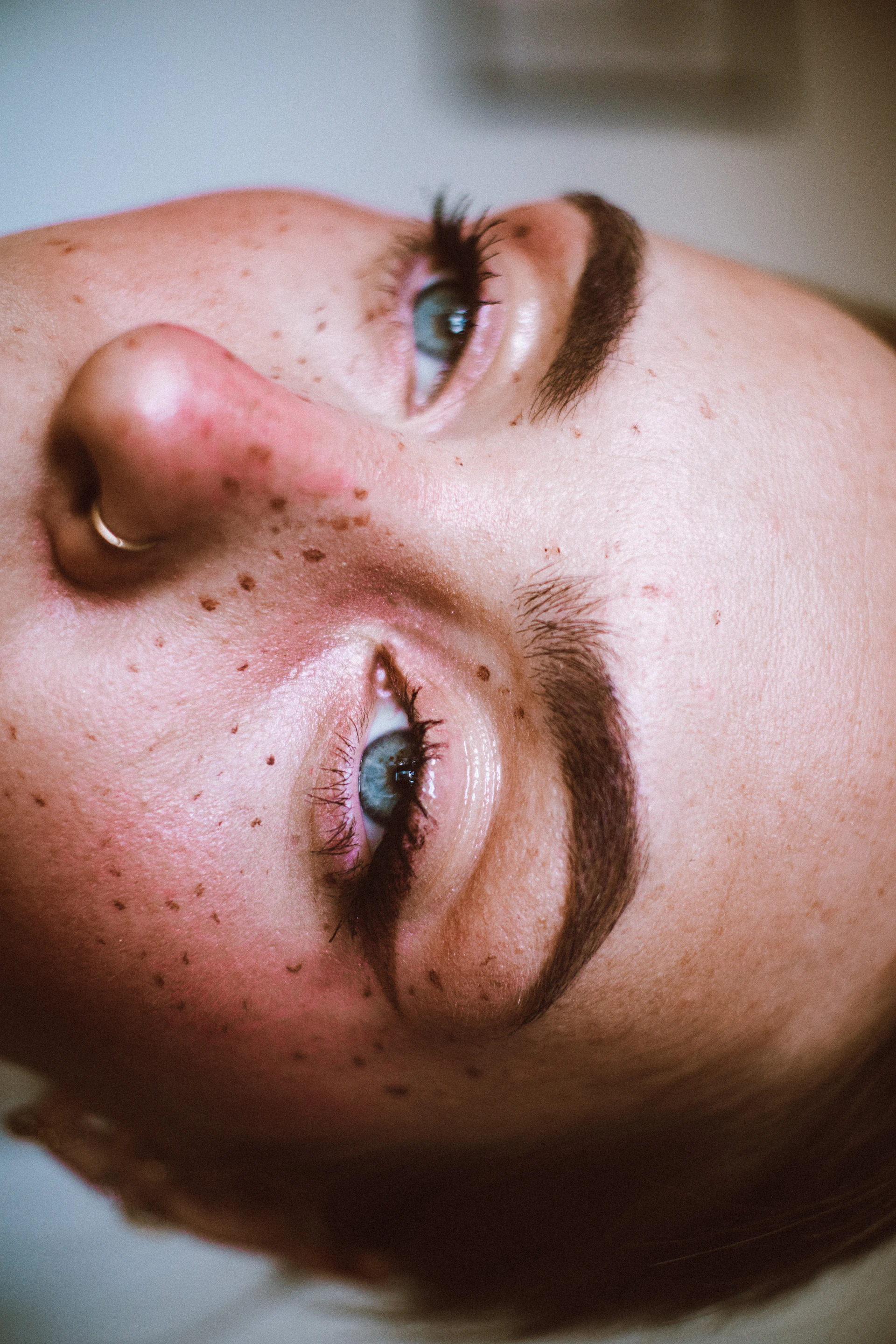 a person's face with a rash on it