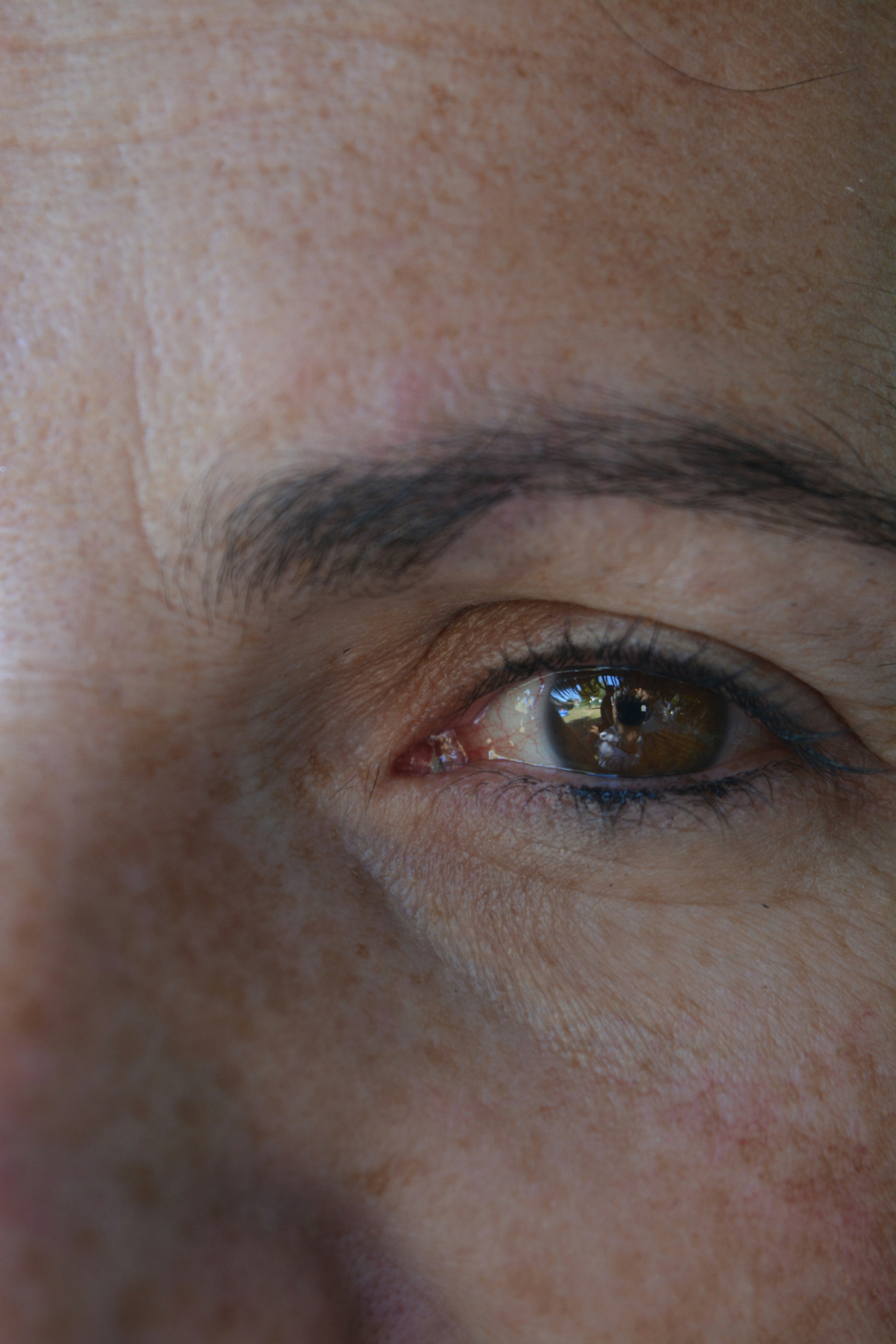 Image of a patient experiencing smoother skin around the eyes post-HIFU