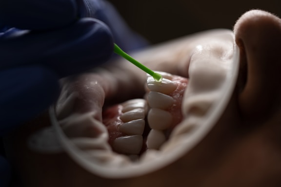 A close-up image of a dental procedure in progress. A dental professional wearing gloves is applying a substance onto the surface of a patient's teeth using a small applicator. The patient's mouth is open, and a dental retractor is being used to keep the lips away from the teeth.