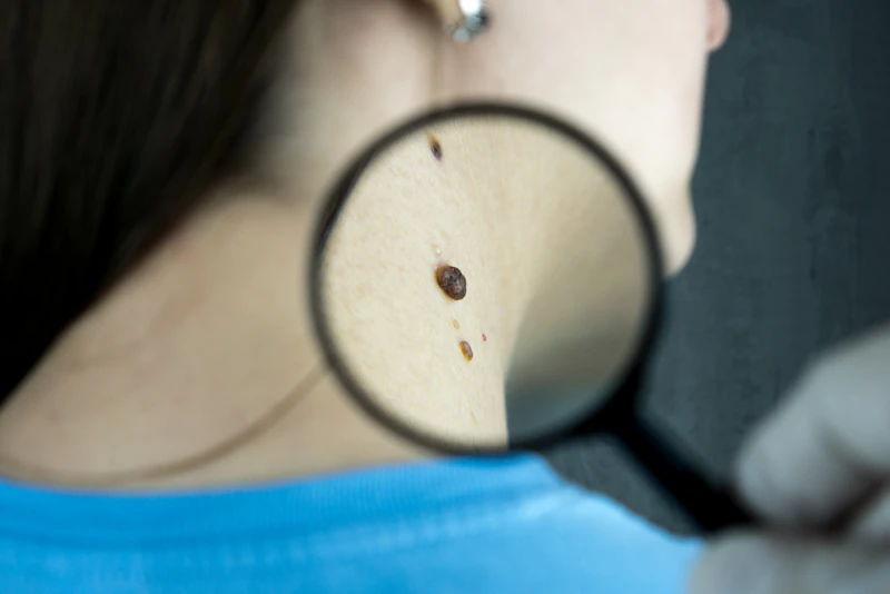 Close-up of a magnifying glass held over skin