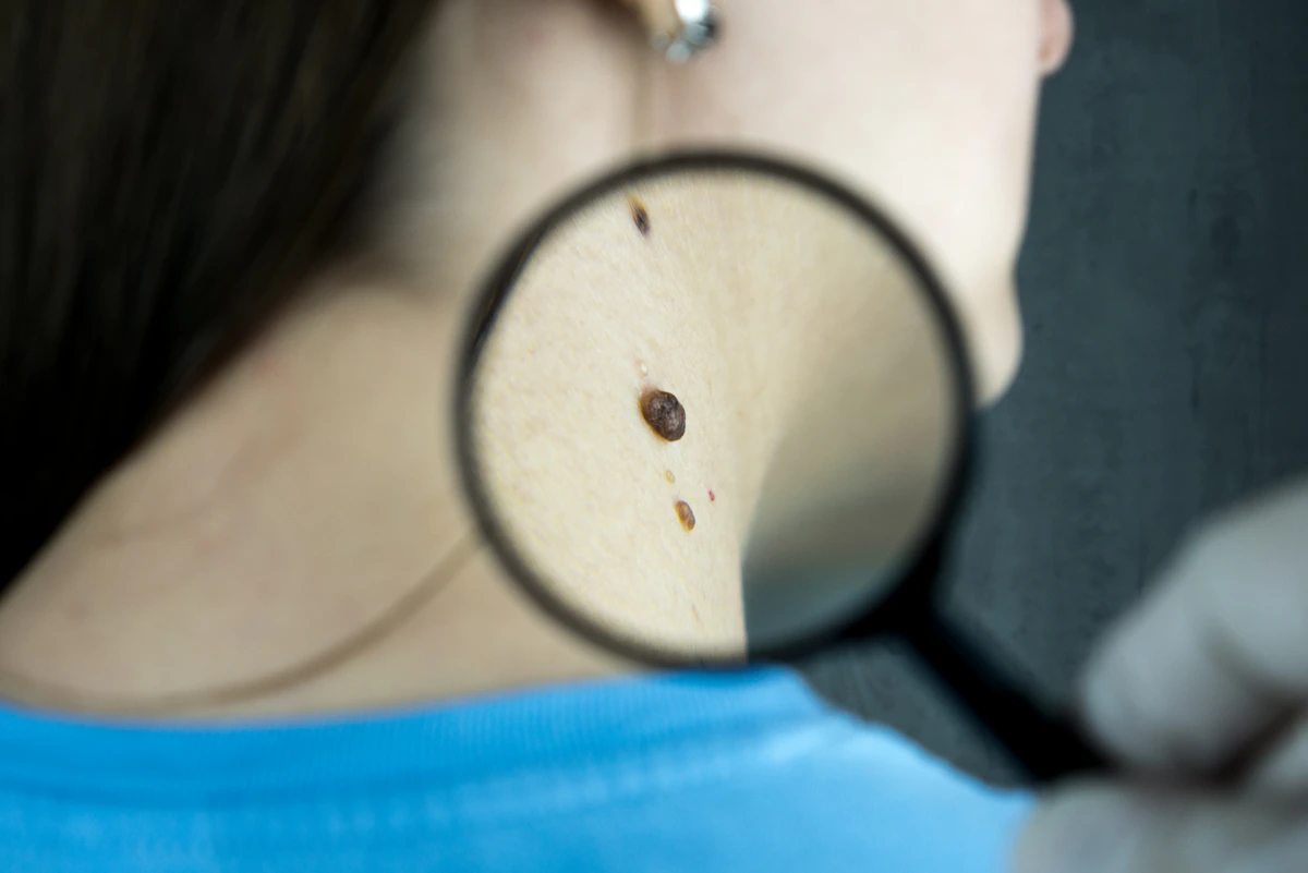 Dermatologist using a magnifying glass to examine a skin lesion in clinic