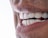 A close-up of a person’s mouth showing a healthy set of white teeth and pink lips. The skin texture and pores around the mouth are visible, indicating a zoomed-in view.