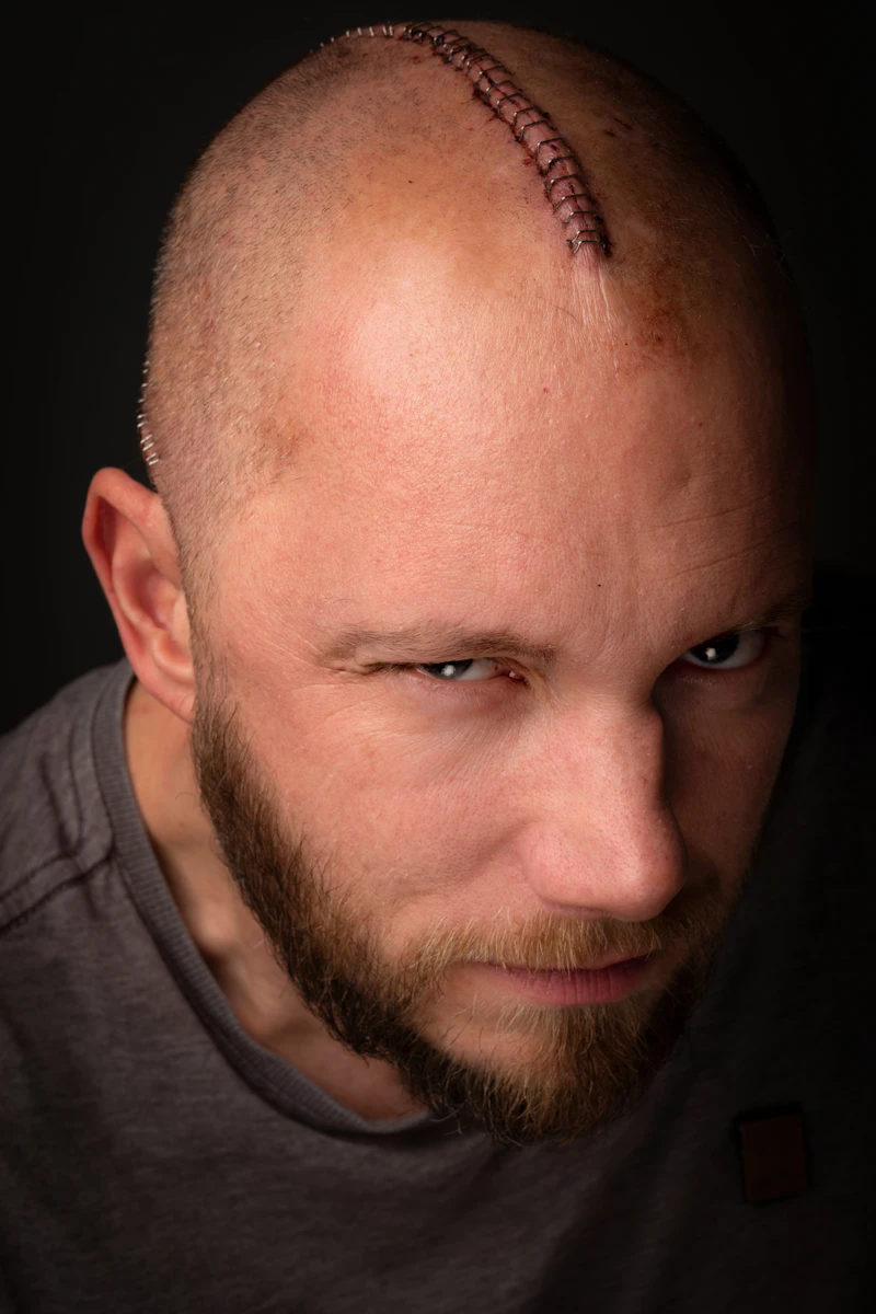 Man showing visible thinning at the crown, a sign to seek medical advice