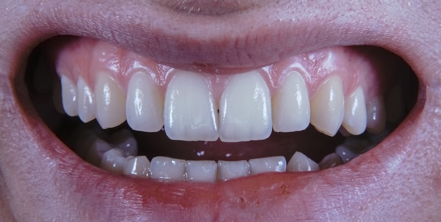 Guided bioprint mock-ups for ridge preservation