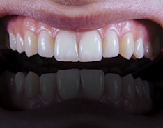 A close-up view of a set of clean, white teeth with healthy gums showing a reflection below.