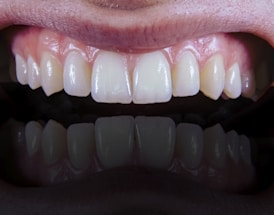 A close-up view of a set of clean, white teeth with healthy gums showing a reflection below.