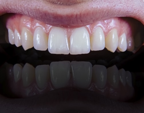 A close-up view of a set of clean, white teeth with healthy gums showing a reflection below.