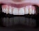 A close-up view of a set of clean, white teeth with healthy gums showing a reflection below.