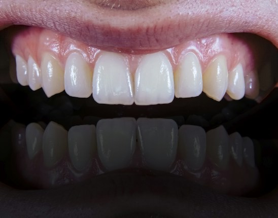 A close-up view of a set of clean, white teeth with healthy gums showing a reflection below.