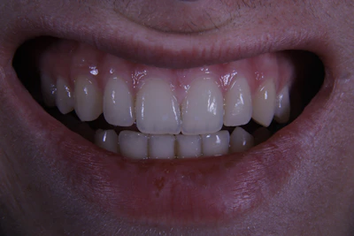a close up of a person's mouth with a missing tooth