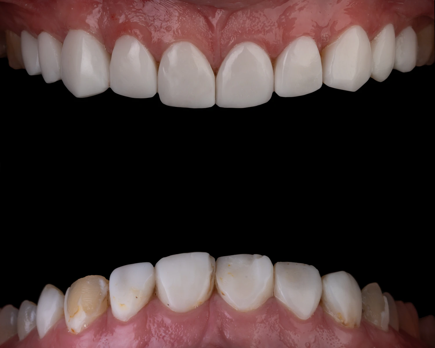 Before and after clear aligners for crossbite and crowding in a 26-year-old adult