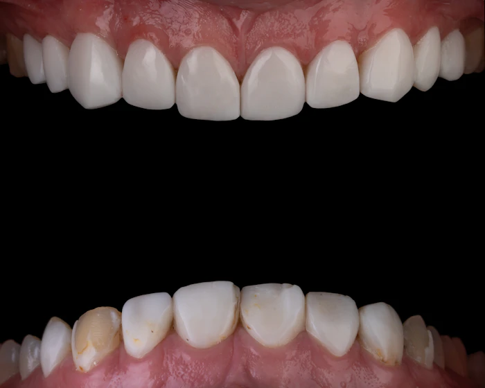 Antes: prótese dentária fixa