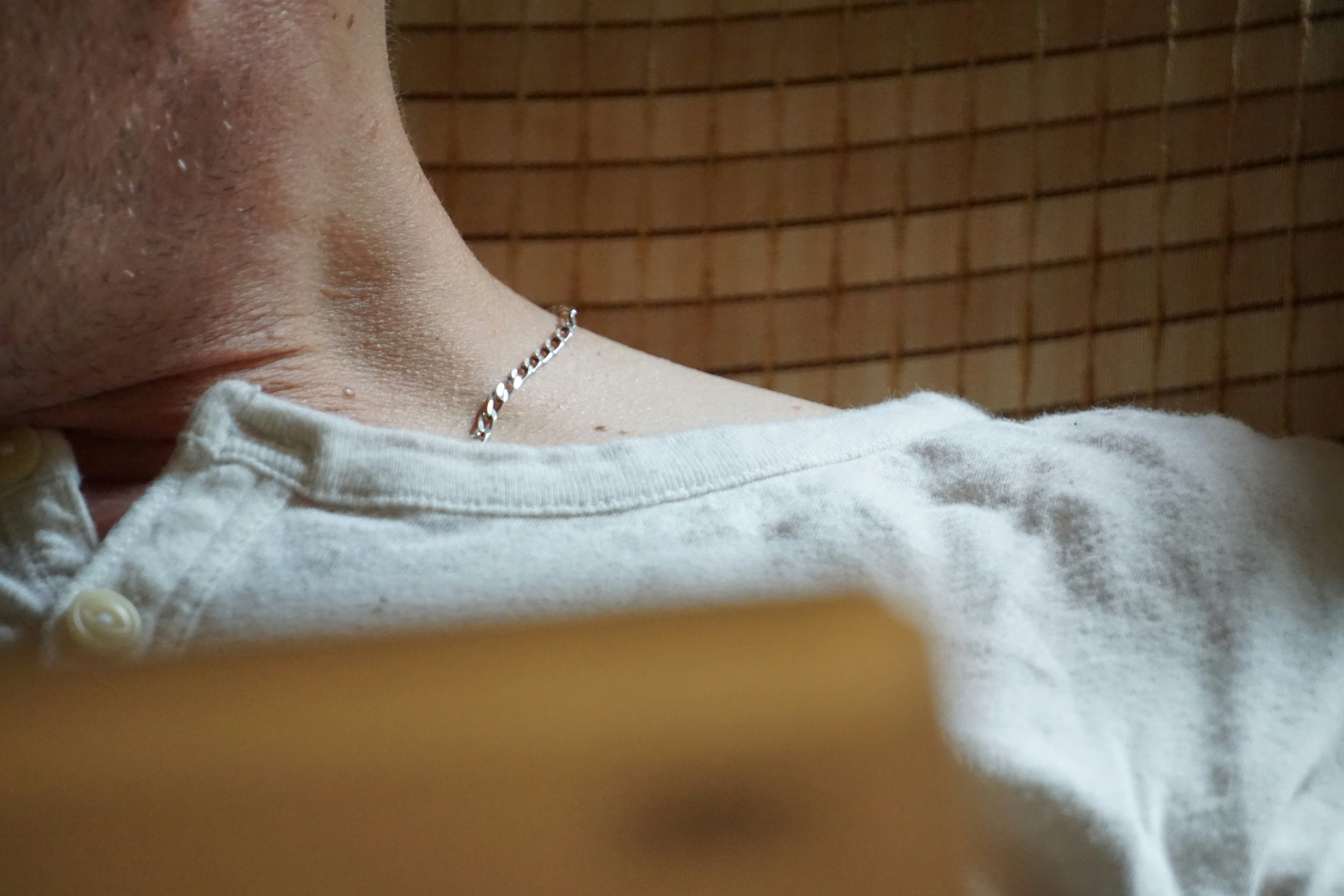 Advanced Strategy: Managing Acne and Post-Inflammatory Hyperpigmentation in Skin of Color (2026)