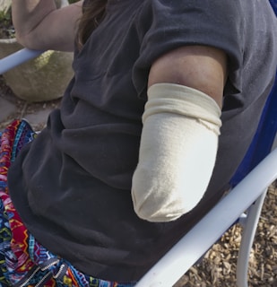 A person is sitting on a chair, wearing a black shirt and colorful patterned pants. Their right arm is amputated and wrapped with a beige bandage or cover. The setting seems to be outdoors, possibly in a garden or patio area.
