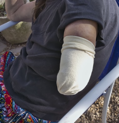 A person is sitting on a chair, wearing a black shirt and colorful patterned pants. Their right arm is amputated and wrapped with a beige bandage or cover. The setting seems to be outdoors, possibly in a garden or patio area.