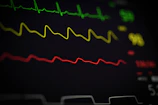 a close up of a computer screen with a line of ecg