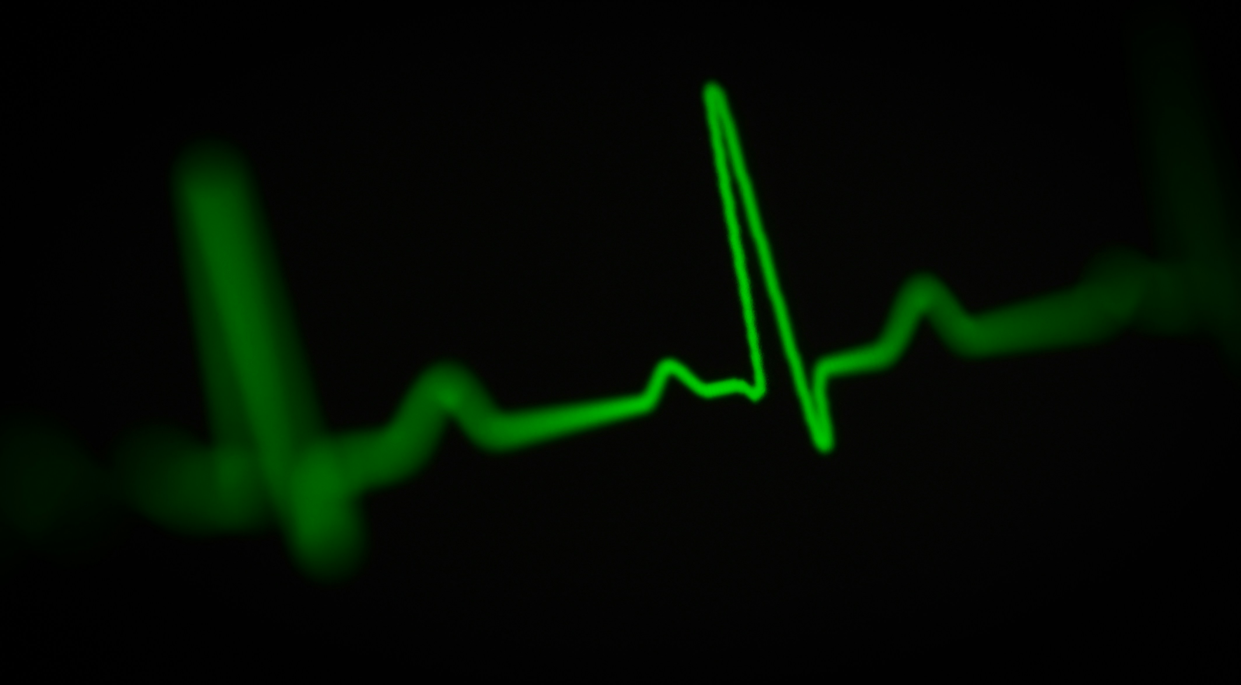 Predicción de riesgo de insuficiencia cardíaca con IA explicable en ECG de 24h
