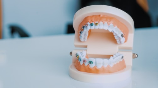 A dental model displaying orthodontic braces on both the top and bottom sets of teeth. The model rests on a glossy white surface, and various colored brackets are visible on the braces. The background is blurred, suggesting a clinical setting.