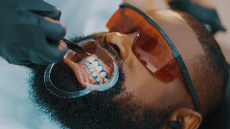 In-chair whitening
