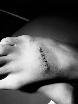 A close-up view of a human foot with several stitches on the top, showing a healing wound. The skin appears slightly bruised, and the stitches are neatly aligned. The image is in black and white, emphasizing texture and contrast.