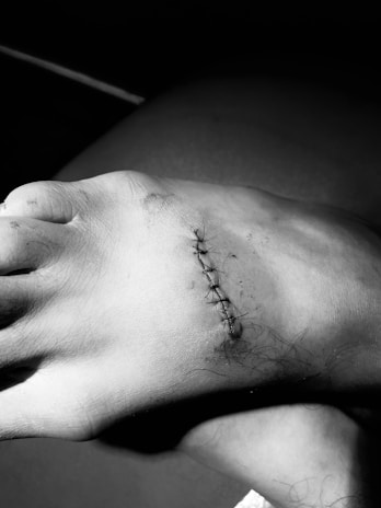 A close-up view of a human foot with several stitches on the top, showing a healing wound. The skin appears slightly bruised, and the stitches are neatly aligned. The image is in black and white, emphasizing texture and contrast.
