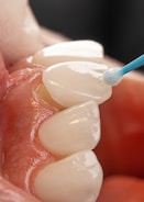 A close-up view of teeth with a dental veneer being applied using a small brush. The teeth appear clean and the veneer is being carefully positioned on the surface.