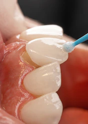 Close-up of a dentist applying a tooth-colored resin filling to a patient's tooth.