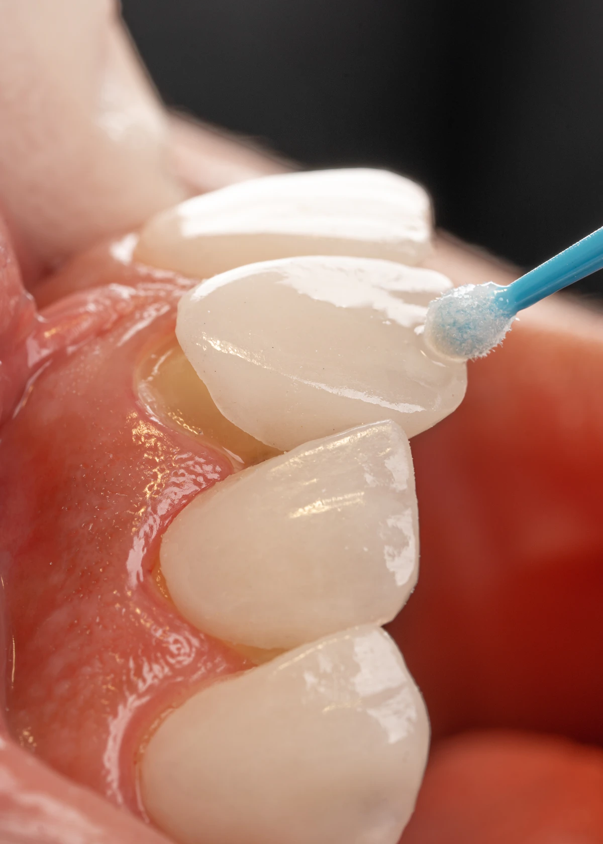 İllüstratif görsel: a tooth with a blue toothbrush in it