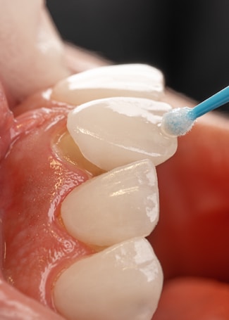 A close-up view of teeth with a dental veneer being applied using a small brush. The teeth appear clean and the veneer is being carefully positioned on the surface.