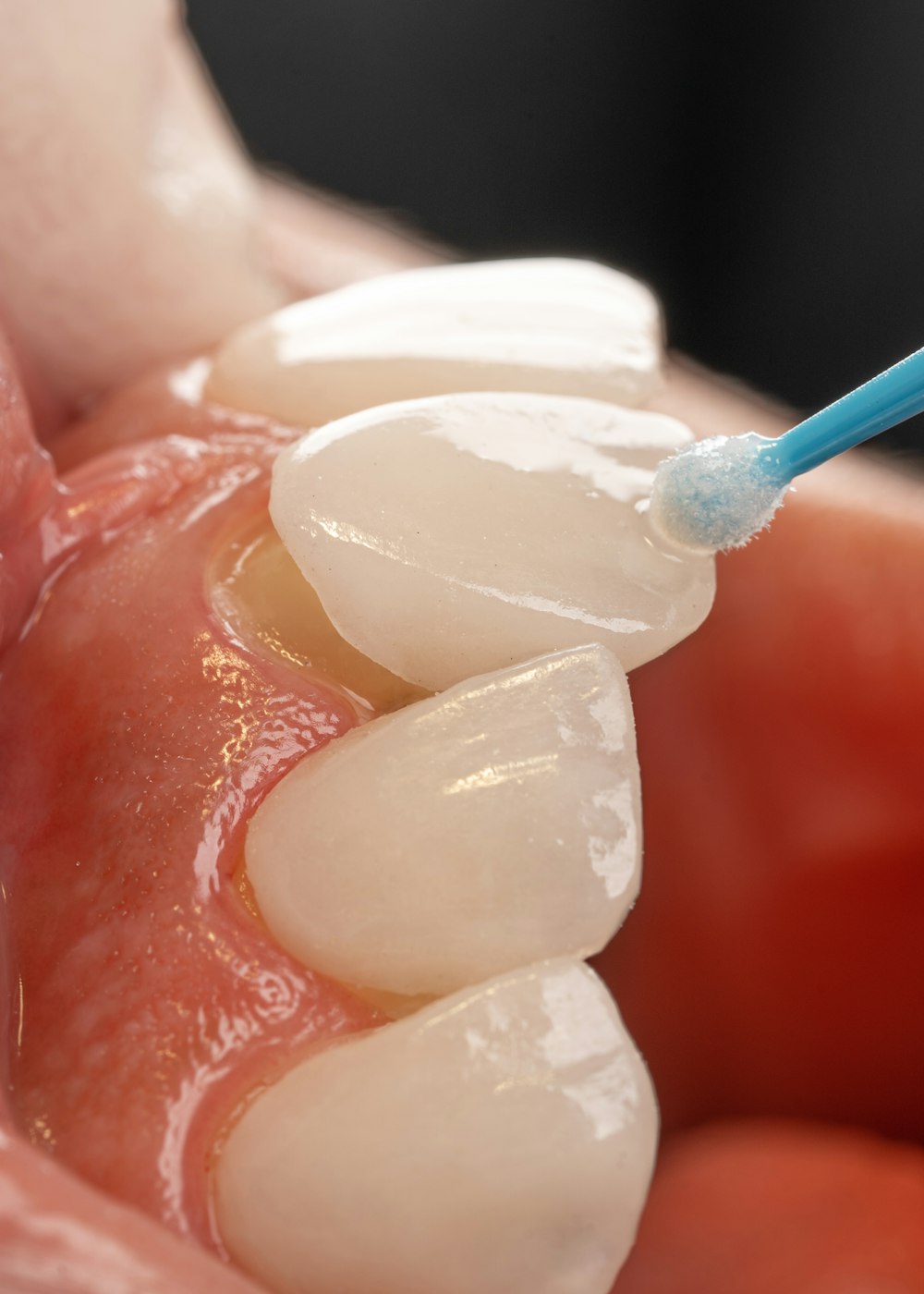 une dent avec une brosse à dents bleue dedans