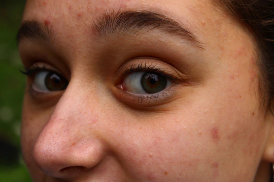 Close-up of a young adult's cheek showing mild acne with a soft clinical background.