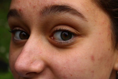 Close-up of a fresh, dewy face with natural acne healing in progress under soft morning light.