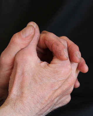 Hand showing claw-like deformities common in advanced CMT 2A.