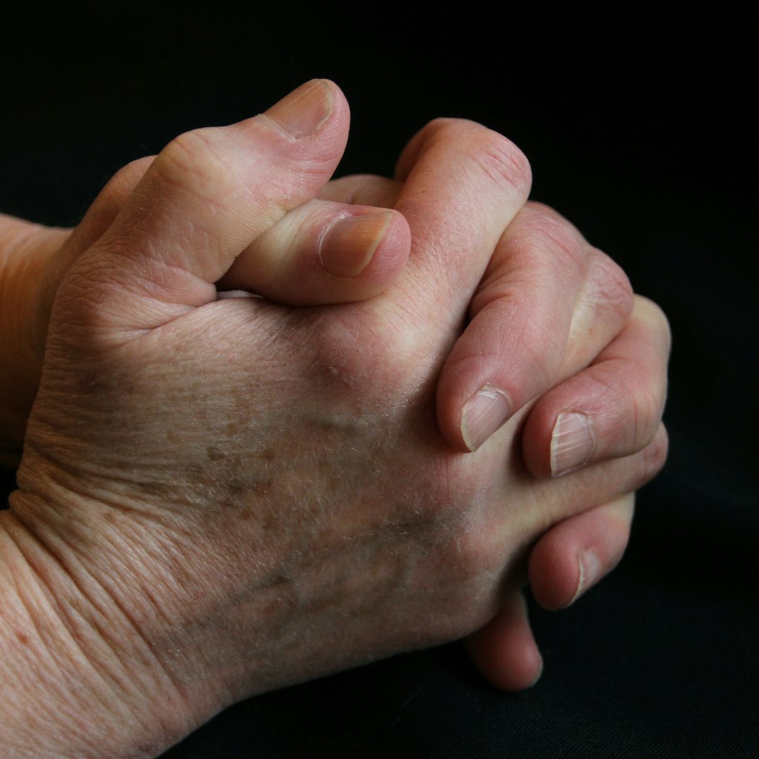 Rheumatoid Arthritis clinical hand assessment