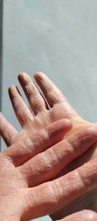 Two hands with dry, cracked skin are prominently displayed against a plain background. The texture of the skin is highlighted, showing detailed features and signs of dryness.