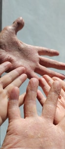 Several hands with dry, flaky skin are held together against a light background, showing visible texture and pale coloring.