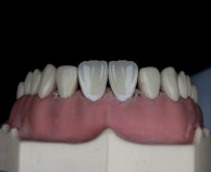 A close-up view of a dental model featuring a full set of artificial teeth with realistic white coloration. The gums exhibit a pink hue, and the teeth are aligned on a display mold against a dark backdrop.