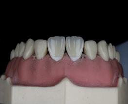 A close-up view of a dental model featuring a full set of artificial teeth with realistic white coloration. The gums exhibit a pink hue, and the teeth are aligned on a display mold against a dark backdrop.