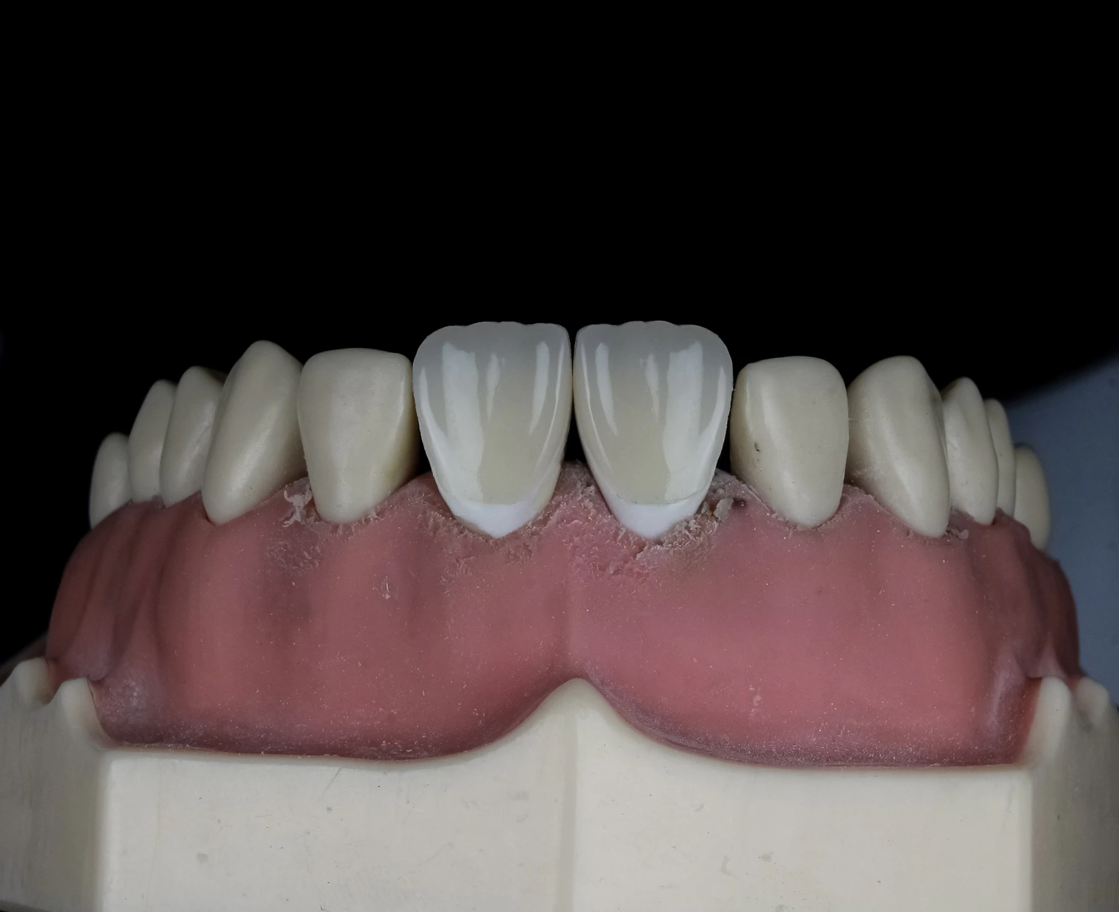 Dental model showing composite veneers on the front teeth