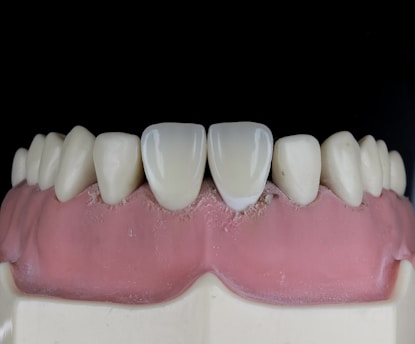 A close-up view of a dental model showcasing upper teeth with a focus on the front two teeth, which appear to be made of a glossy, reflective material. The gums are also visible, depicted in a pink color, and the overall context suggests a dental setting or demonstration.