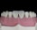 A close-up view of a dental model showcasing upper teeth with a focus on the front two teeth, which appear to be made of a glossy, reflective material. The gums are also visible, depicted in a pink color, and the overall context suggests a dental setting or demonstration.