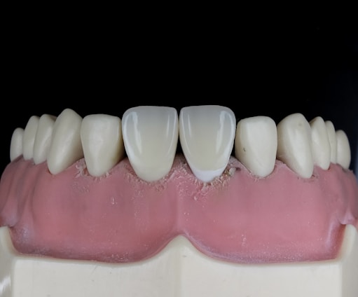 A close-up view of a dental model showcasing upper teeth with a focus on the front two teeth, which appear to be made of a glossy, reflective material. The gums are also visible, depicted in a pink color, and the overall context suggests a dental setting or demonstration.