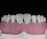 A close-up view of a dental model showcasing upper teeth with a focus on the front two teeth, which appear to be made of a glossy, reflective material. The gums are also visible, depicted in a pink color, and the overall context suggests a dental setting or demonstration.