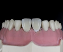A close-up view of a dental model showcasing upper teeth with a focus on the front two teeth, which appear to be made of a glossy, reflective material. The gums are also visible, depicted in a pink color, and the overall context suggests a dental setting or demonstration.