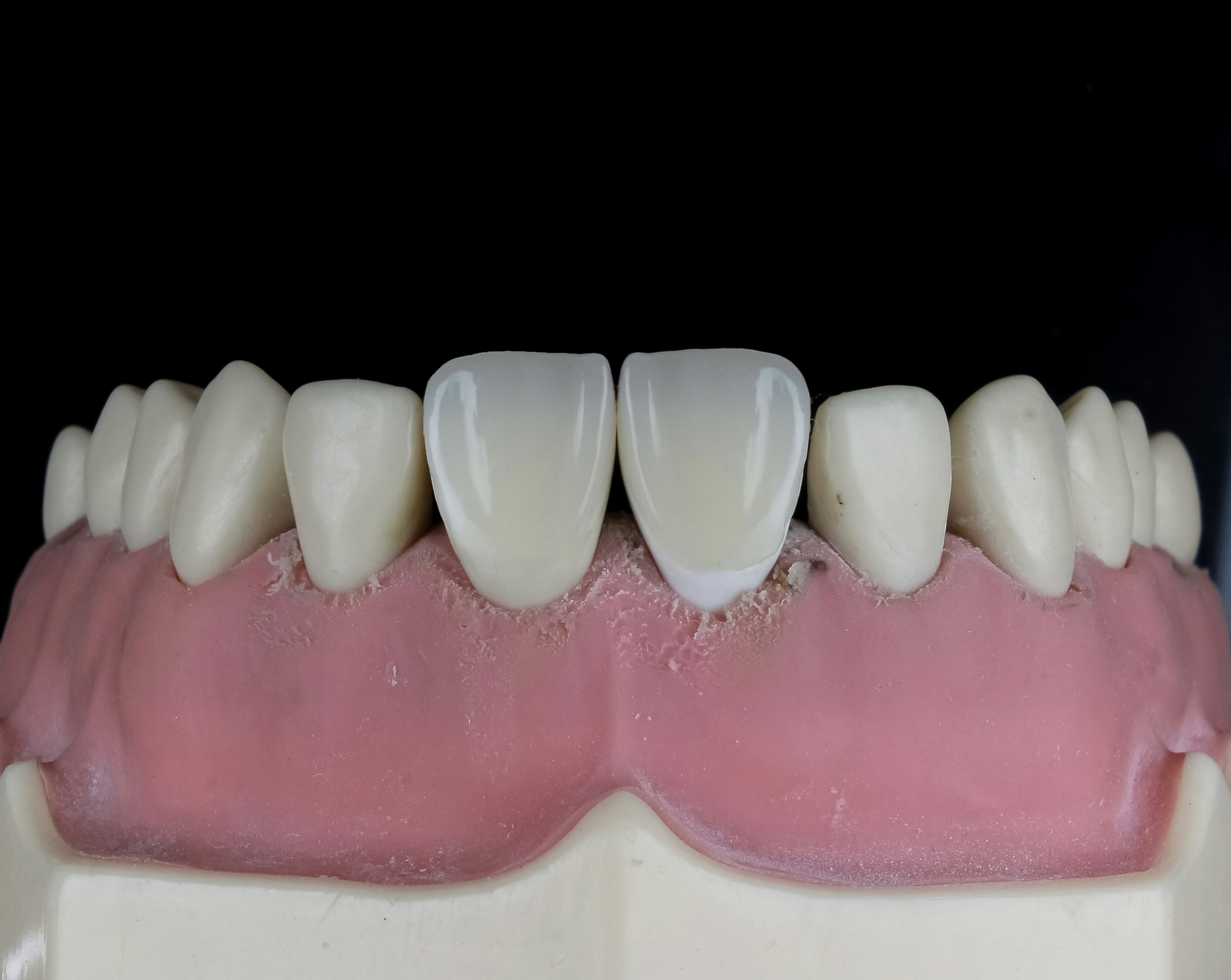 Before and after photos showing ceramic crown repair and replacement options - ceramic teeth cap
