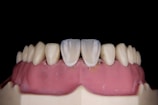 A close-up of a dental model showing human gums and teeth. The model includes two central incisors which are whiter than the surrounding teeth.